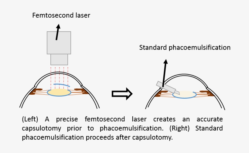 What Is Laser-assisted Cataract Surgery - Diagram, transparent png download