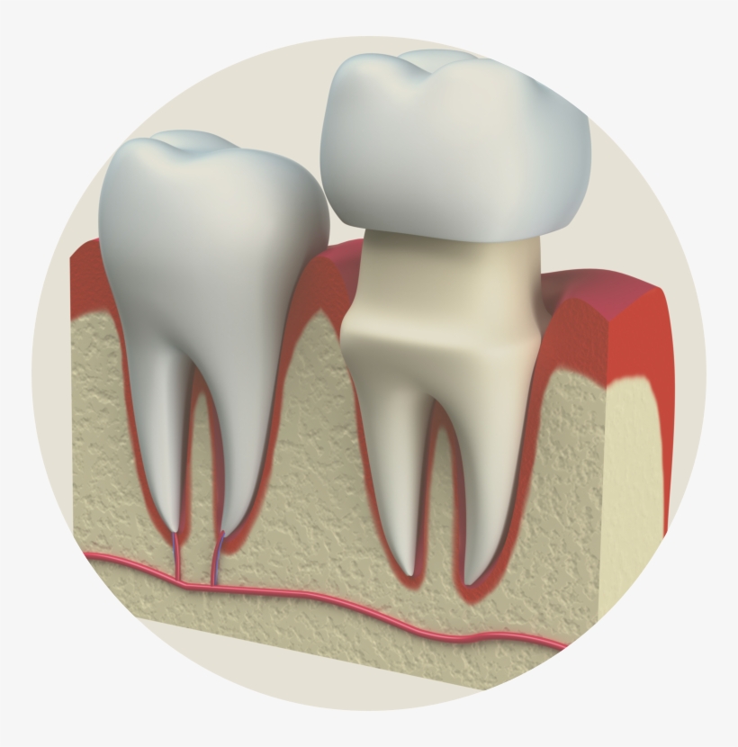 During This Time A Temporary Crown Is Worn - Tooth Porcelain Figure Png, transparent png download