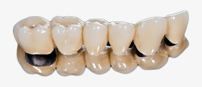Are Crowns Made On Site Or In A Dental Laboratory All - Crowns And Bridges Fixing, transparent png download