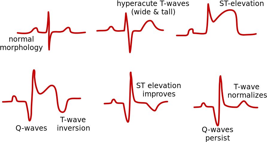 Monitor Like A Pro - Progression Of Stemi On Ecg (920x480), Png Download