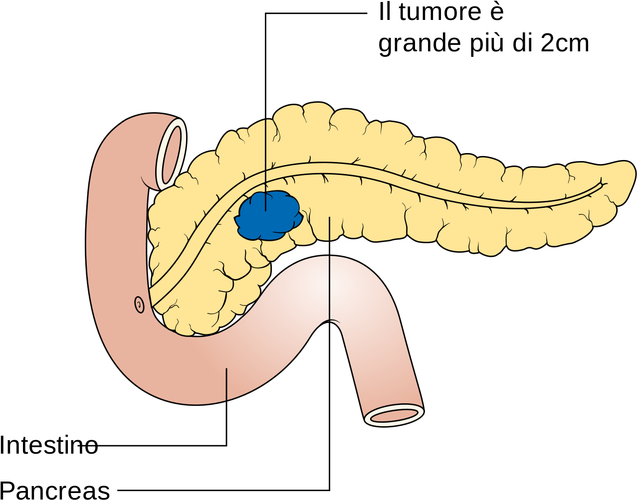 Diagram Showing Stage T2 Cancer Of The Pancreas Cruk - Tumore Wikipedia (1280x1023), Png Download