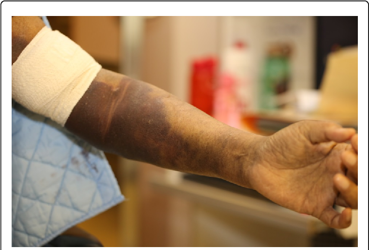 Hematoma Of Left Anterior Cubital Fossa, After Blood - Cubital Fossa (769x520), Png Download