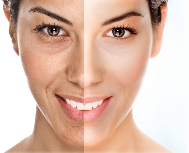 Dermapen Vs Laser Co2 (619x500), Png Download