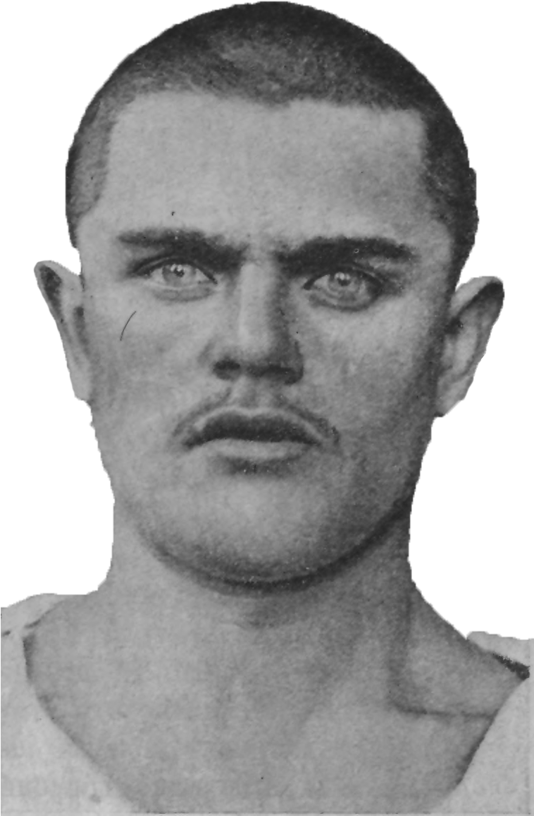 Epilepsy, Age 20 - Wikimedia Commons (757x1202), Png Download