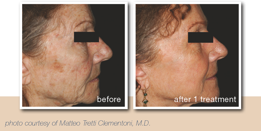 Before And After Pictures For Patients With Deep Wrinkles - Patient (907x457), Png Download