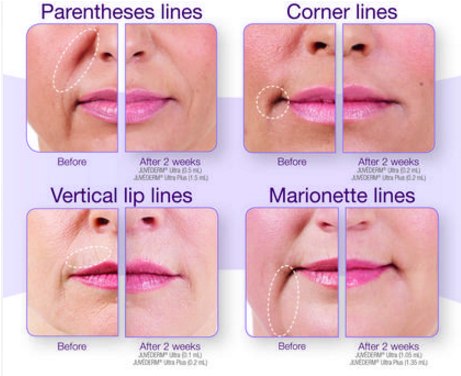 You Can Expect A Little Redness And Swelling Over The - Best Filler For Lip Lines (1000x600), Png Download