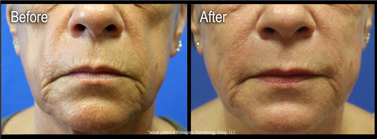 Are Injectable Gels Used To Restore Fullness And Volume - Animal (1600x700), Png Download
