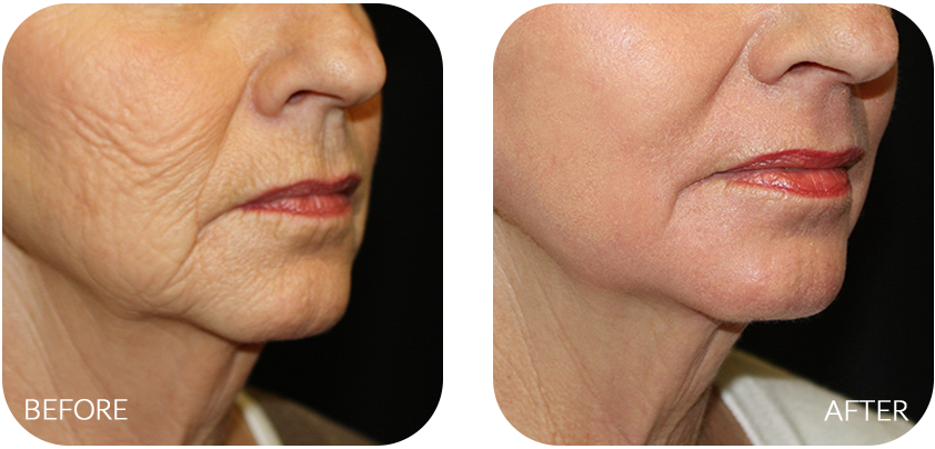 Wrinkles, Creases, And Sags Are Inevitable As We Age - Chemical Peel (842x404), Png Download