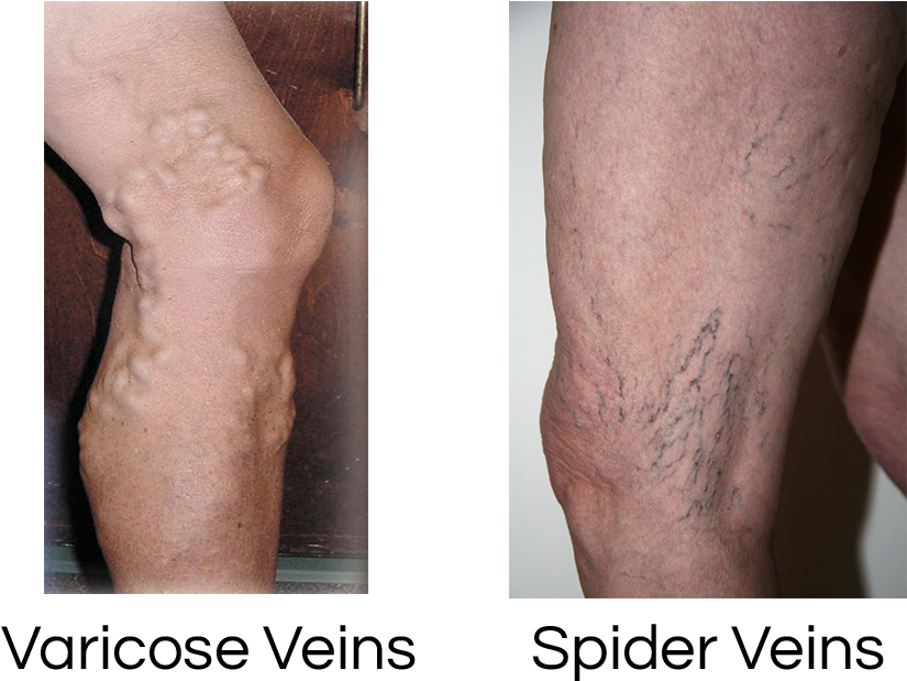 Vein Disorders - Spider Veins (870x618), Png Download