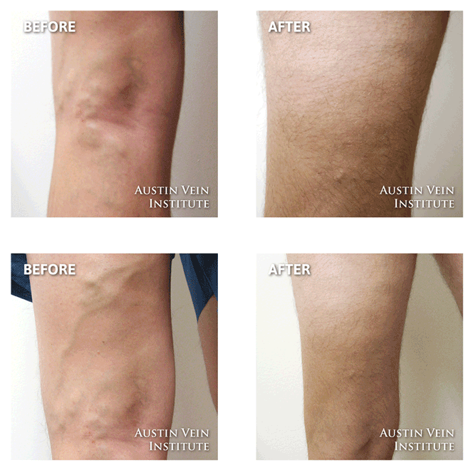 Case - Before And After Long Distance Running (720x720), Png Download