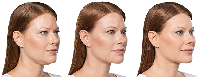 Weight Before Treatment - Chin Weight Loss Before And After Side Profile (738x251), Png Download