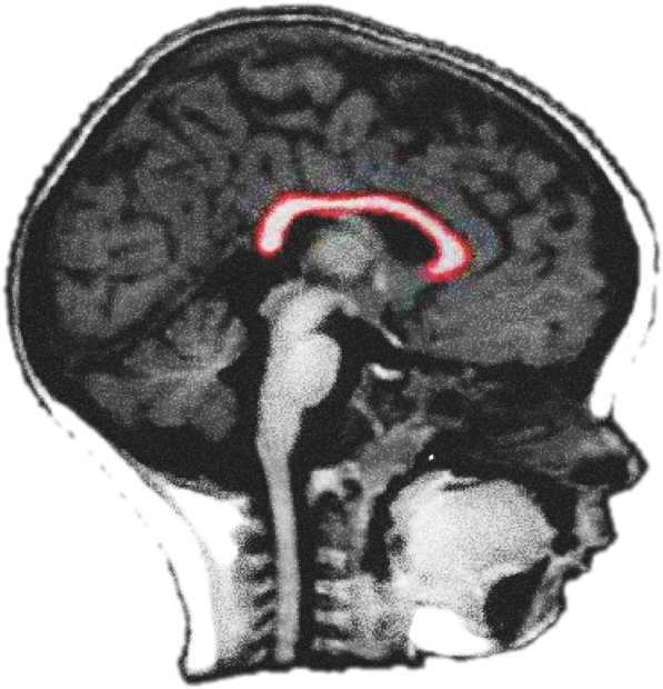 1 - Corpus Callosum Baby Mri (663x675), Png Download