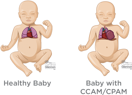 How Are Lung Masses Diagnosed And Managed During Pregnancy - Congenital Cystic Adenomatoid Malformation Ccam (620x520), Png Download