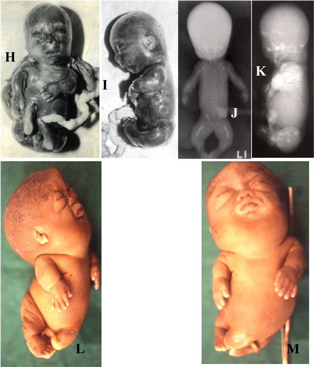 (r) Showing Lethal Skeletal Dysplasia - Platyspondylic Lethal Skeletal Dysplasia, Torrance (902x744), Png Download