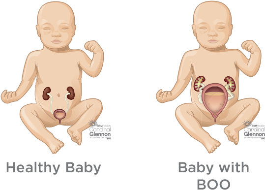 Bladder Outlet Obstruction - Baby Kidney (620x520), Png Download