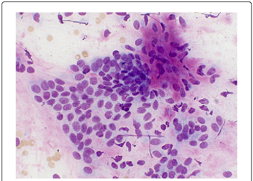 Components Of A Mixed Mammary Tumor In A Female Canine - Mammary Carcinoma Dog Cytology (513x367), Png Download