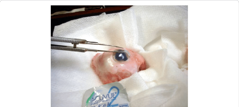 Acuvue 2 Contact Lens Being Placed On An Enucleated - Acuvue 2 Contact Lenses (761x343), Png Download
