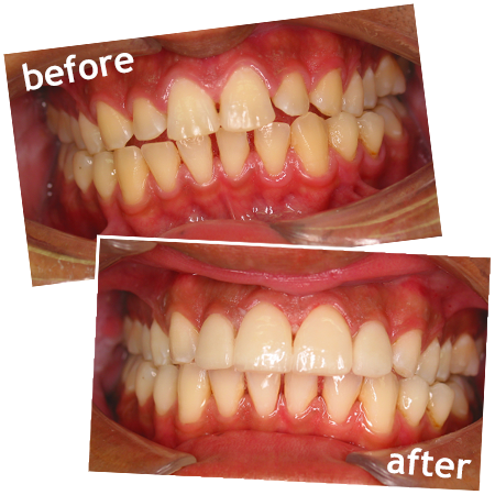 Glamsmile Porcelain Veneers Before After Sidebar - Veneer (450x450), Png Download