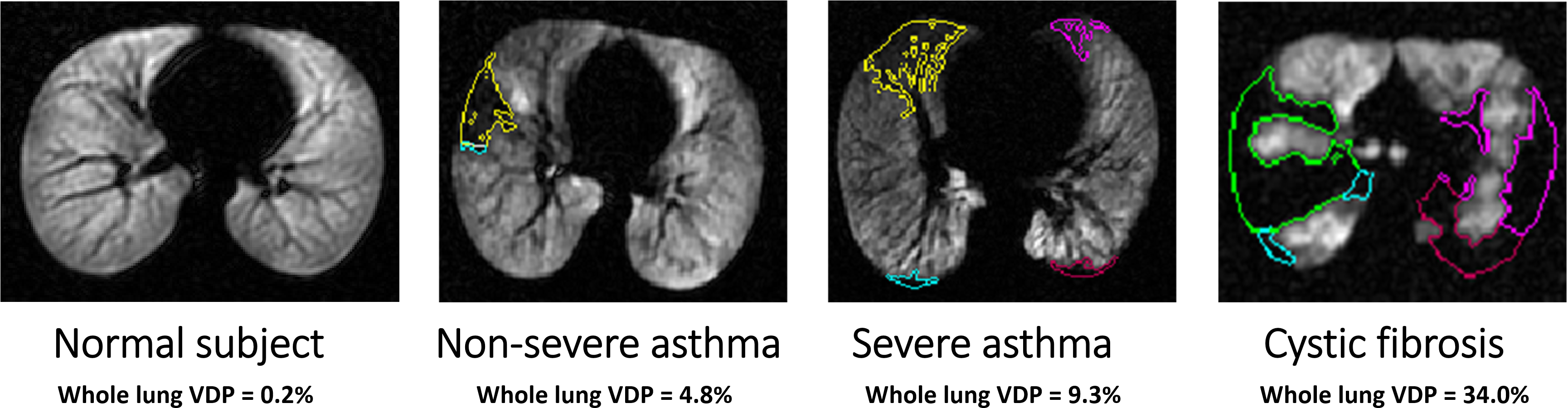 Examples Of Detected Ventilation Defect Boundaries - Magnetic Resonance Imaging (3460x938), Png Download