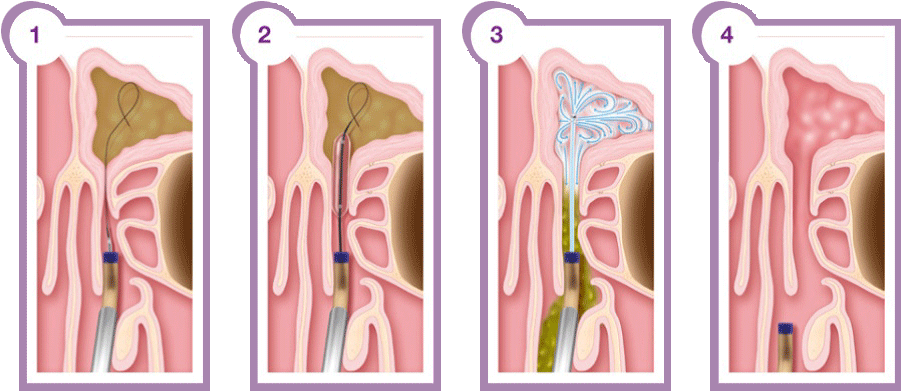 Balloon Sinuplasty Is A New Minimally Invasive Sinus - Functional Endoscopic Sinus Surgery Steps (940x422), Png Download