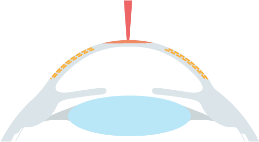 Epi Lasik/lasek/prk/no Touch Prk Schritt - Lasik (560x360), Png Download
