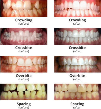 Improve Your Smile, Your Confidence & Your Life - Does Invisalign Work (395x439), Png Download
