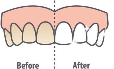 Course Of Treatment Or Treatments That Can Be Made - Teeth Whitening Clipart (500x333), Png Download