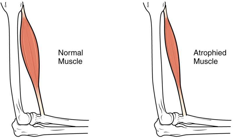Learn How The Freedom Bed™ Helps Reduce Complications - Muscle Atrophy (800x474), Png Download