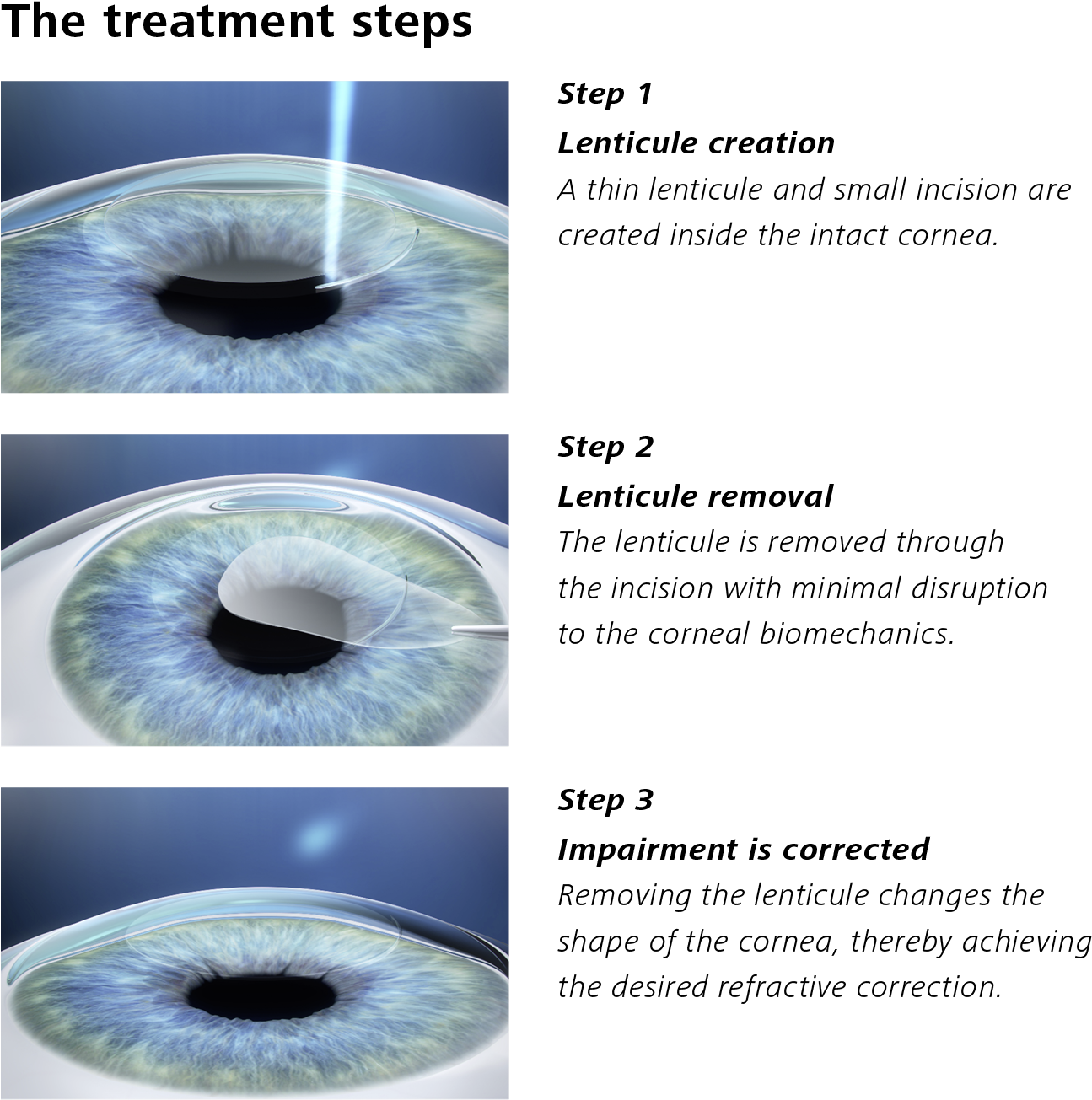 Description Of Treatment Steps With Smile - Zeiss Smile (1323x1327), Png Download