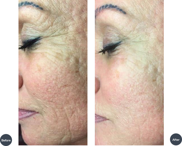 Treatment Of Skin Texture And Rejuvenation - Scar (591x475), Png Download