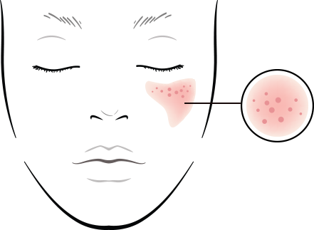 Light Beams Hinder Sebum Production And Imporoves Skin - Cible De Tir A Imprimer (441x323), Png Download