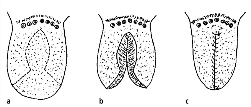 The "keyhole" Technique Is Used For Surgical Reduction - Keyhole Glossectomy (850x364), Png Download