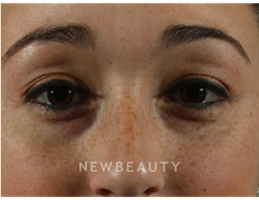 Dr Marina Peredo Restylane B - Close-up (367x441), Png Download