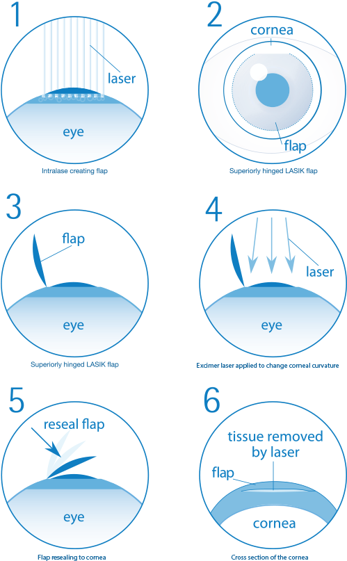 Are You Suitable For Laser Eye Surgery - Lasik Eye Surgery Steps (500x813), Png Download
