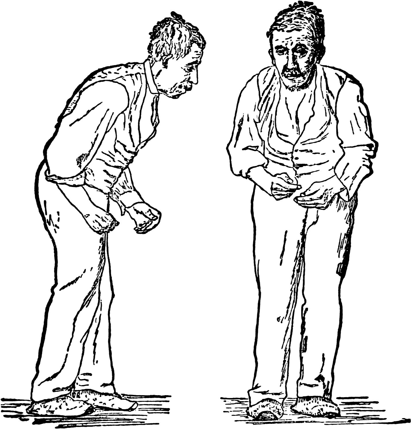 Paralysis Agitans Parkinsons Disease (1500x1580), Png Download