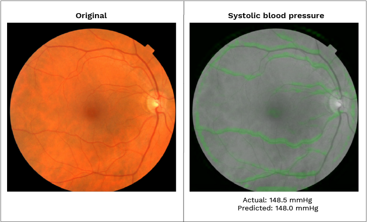 An Original Image Of The Interior Rear Of The Eye And - Lca Retina Vs Normal (750x487), Png Download