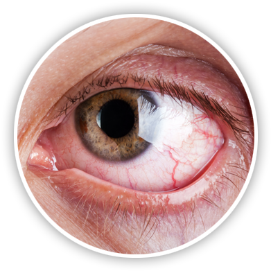 Dry Eyes San Antonio - Mild Uveitis (400x404), Png Download