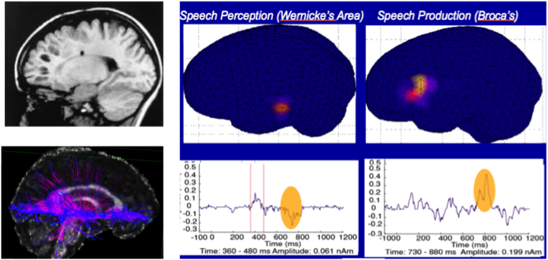 New Neuroimaging Techniques Are Beginning To Outline - Bilingual Brain Structure (771x366), Png Download