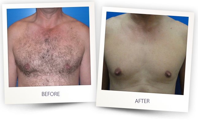 Hair Chest - Depilacion Del Pecho Antes Despues (646x396), Png Download