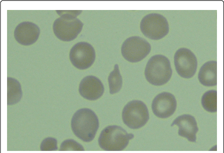 Peripheral Blood Smear With Schitocytosis - Circle (769x524), Png Download