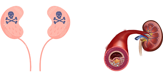 Kidney Failure - Kidney Failure Png (848x296), Png Download
