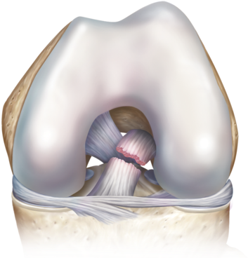 Acl Tear 0 Large - Torn Acl Png (400x370), Png Download