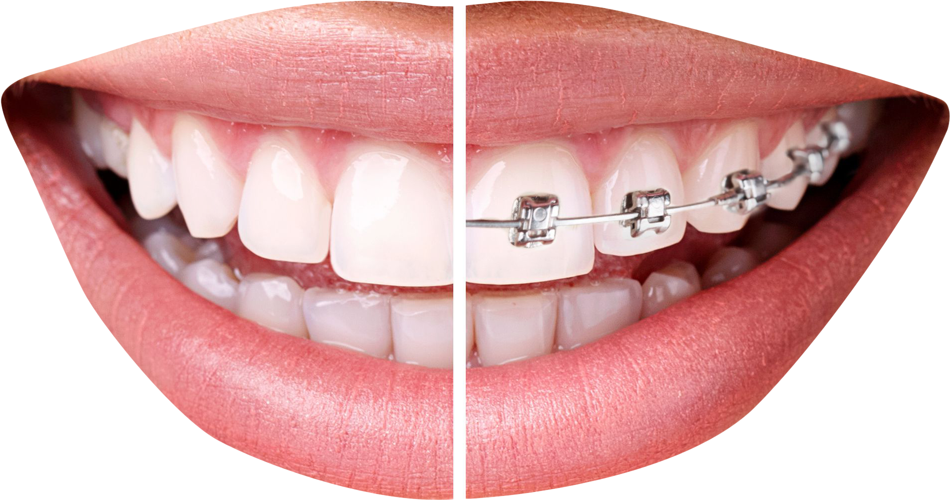 2135 X 1656 - Braces Png (2135x1656), Png Download
