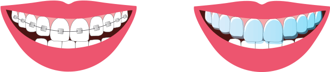 Braces Are Dental Devices Used To Straighten Crooked - Clear Aligners (650x200), Png Download