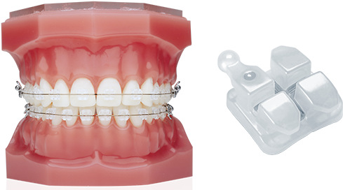 Transparent Brace Plastic - Ceramic Braces Vs Invisalign (500x279), Png Download