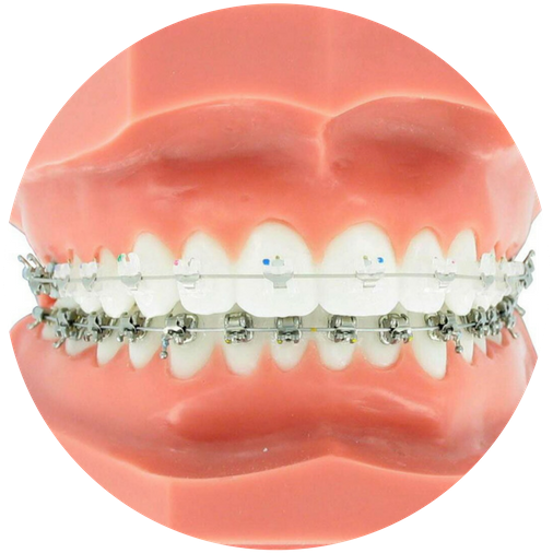 Clear Braces (555x560), Png Download
