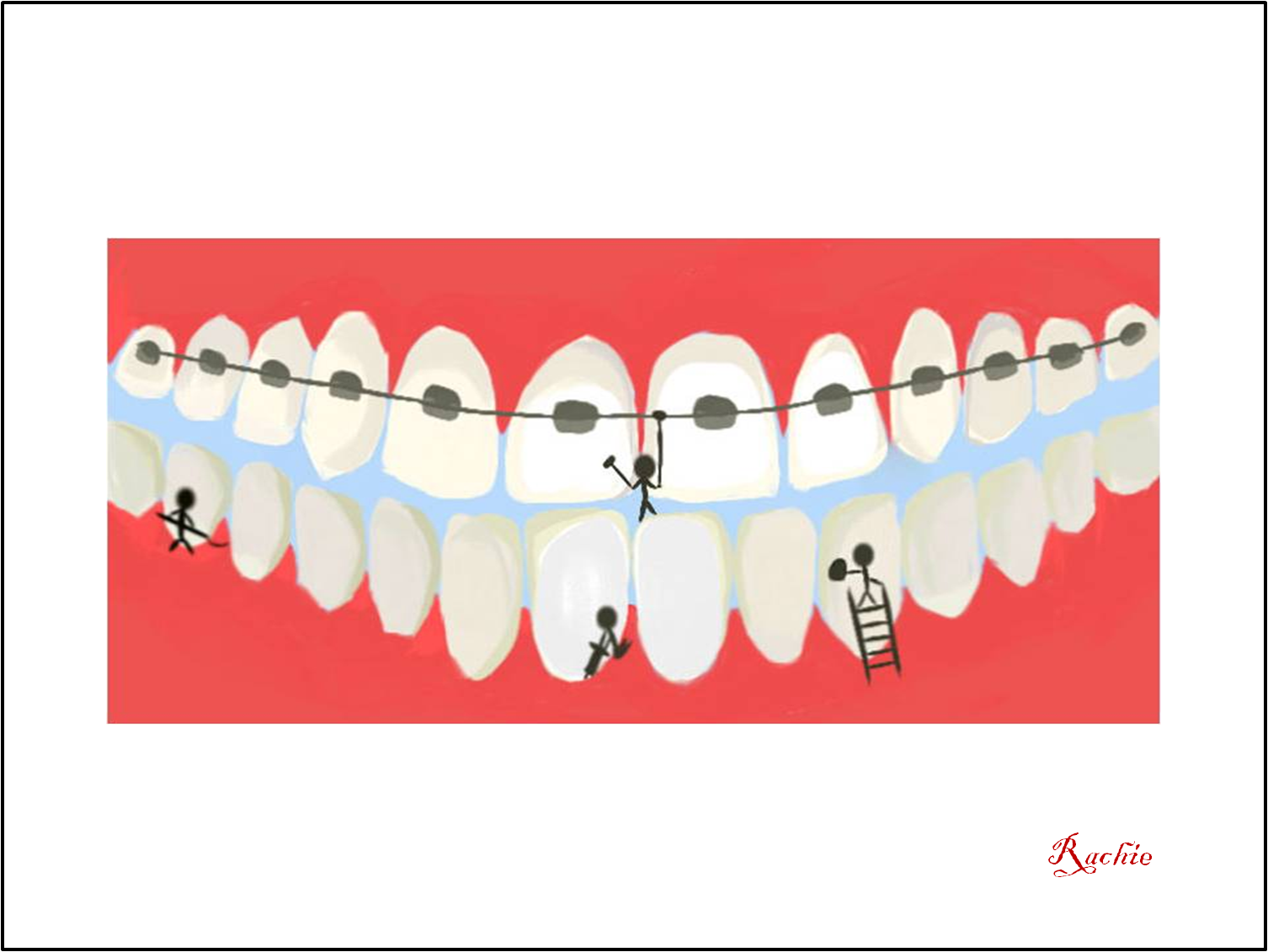Braces Cleaning - Diagram (1506x1131), Png Download