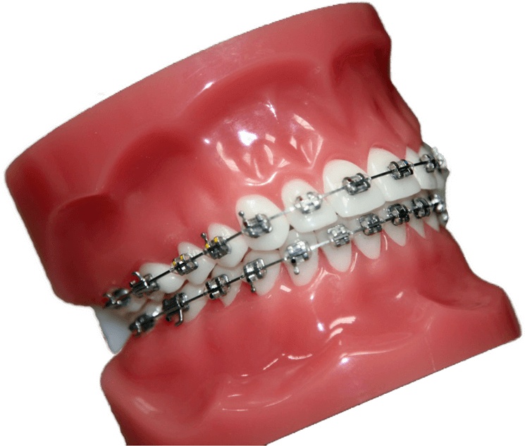 Buccal Braces - Ring (817x637), Png Download