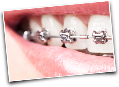 Braces - Best Way To Bond Orthodontic Brackets To Composite (411x303), Png Download