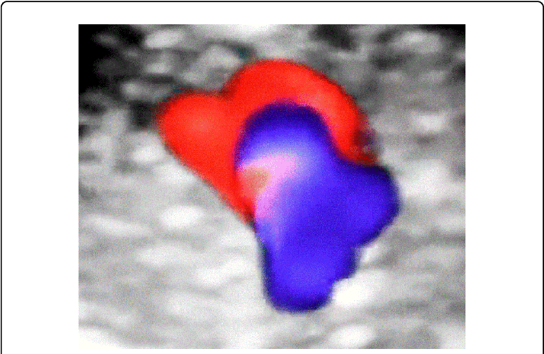Late First Trimester 3d Reconstruction Of The Fetal - 3d Reconstruction (769x499), Png Download